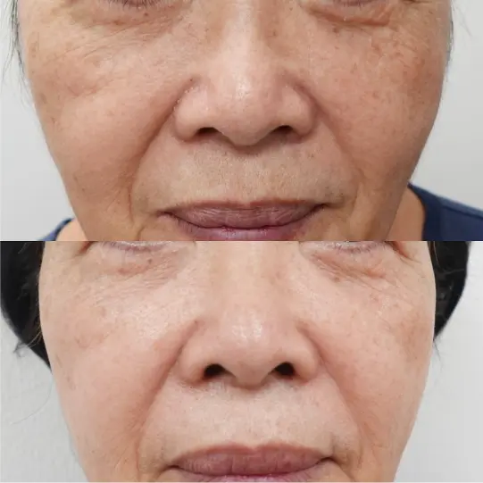 顔広範囲の肝斑含む色素沈着の症例1